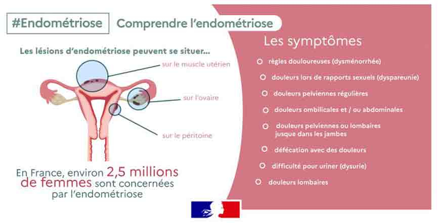 Schéma Endométriose