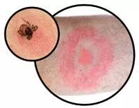 Visuel erythème tique lyme